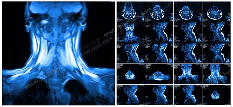 عکس با کیفیت آزمایش MRI از گردن و ستون فقرات به همراه مهره های آن جهت تشخیص بیماری دیسک گردن