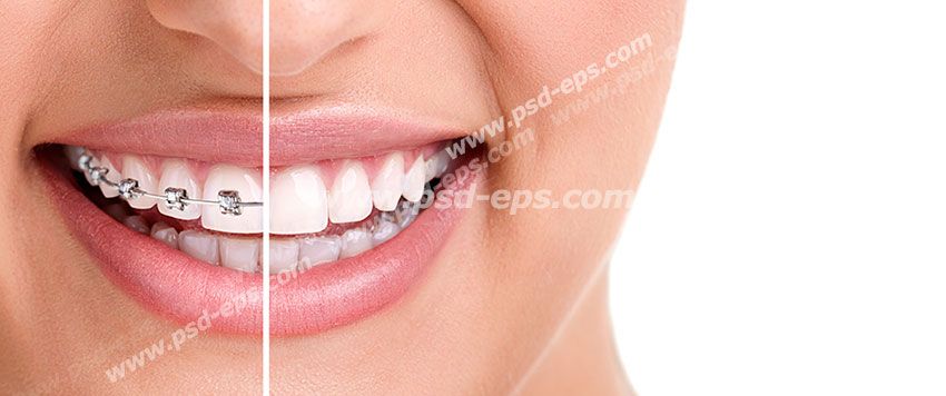 عکس با کیفیت تبلیغاتی دندان های تا نیمه ارتودنسی شده و نیمه دیگر سالم و سفید